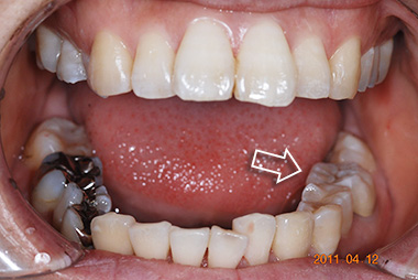 治療後プレビュー