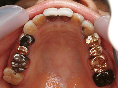 治療前プレビュー