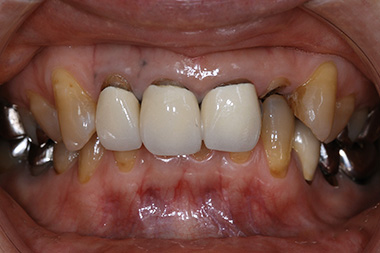 治療前プレビュー