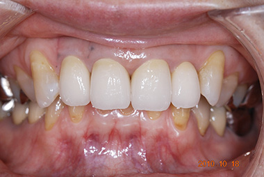 治療後プレビュー