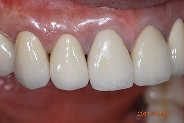 治療後プレビュー