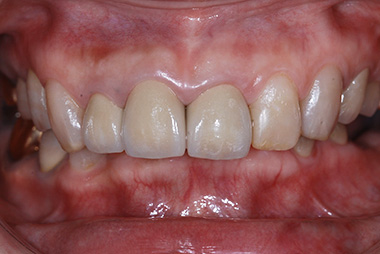 治療後プレビュー