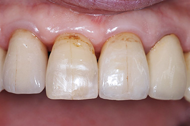 治療後プレビュー