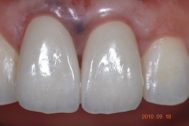 治療後プレビュー