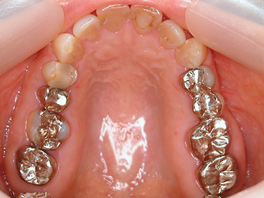 治療前プレビュー