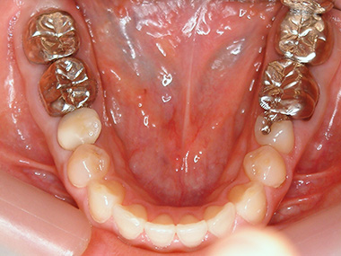 治療前プレビュー