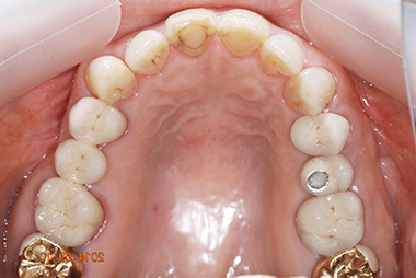 治療後プレビュー