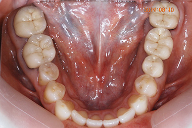 治療後プレビュー