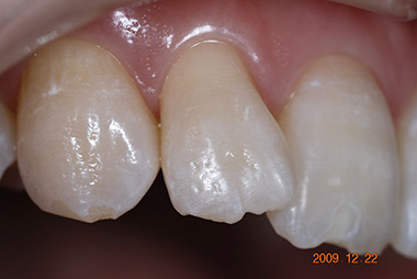 治療前プレビュー