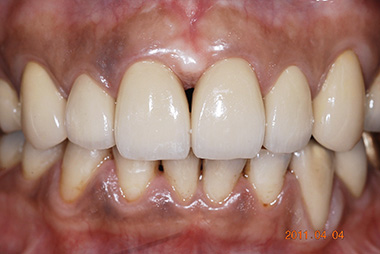 治療後プレビュー