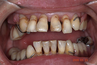 治療前プレビュー