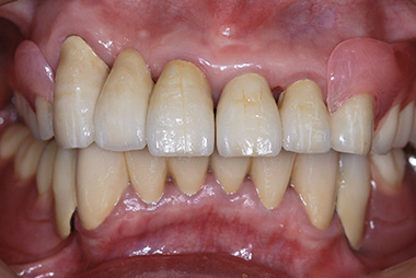 治療後プレビュー