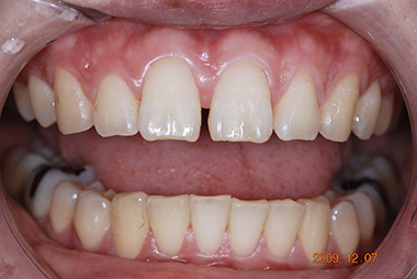 治療前プレビュー