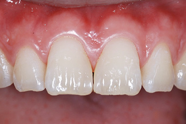 治療後プレビュー