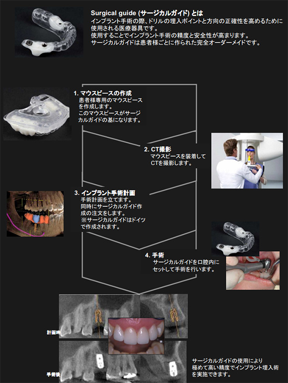 サージカルガイドを使用したインプラント治療