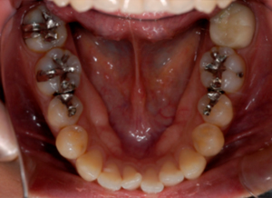 セラミックインレー下顎 治療前