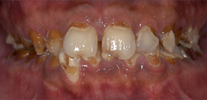 オールセラミック治療前1